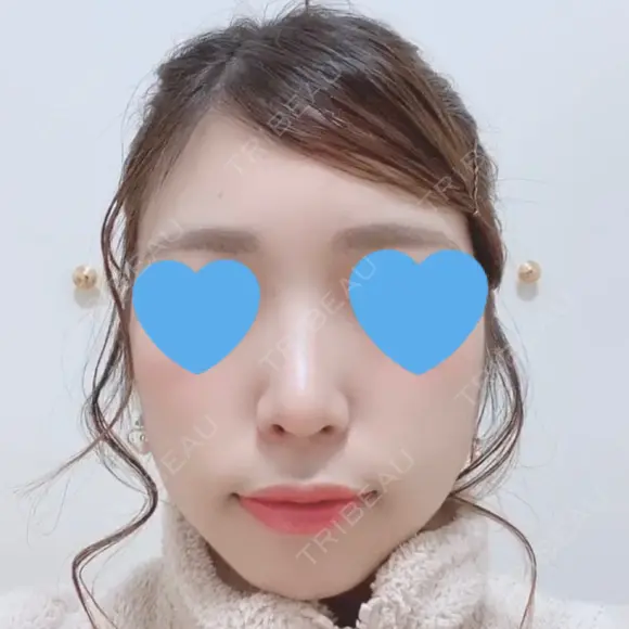 鼻中隔延長（切開） / 軟骨移植 / 鼻尖縮小 HANABI整形外科 DAY 73 メイン用