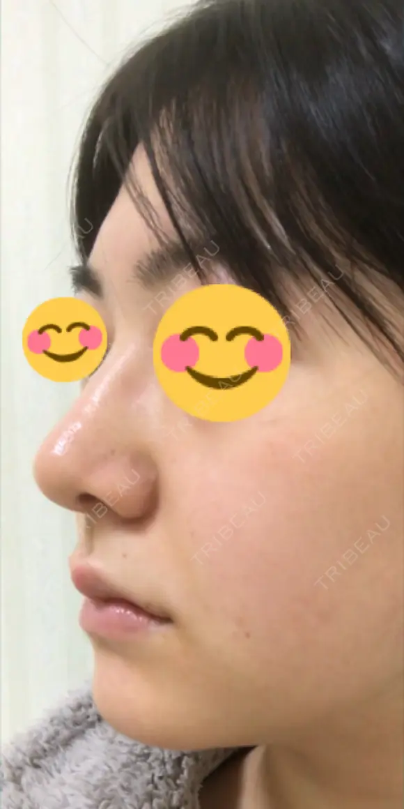 鼻尖形成（切開） / 鼻中隔延長（切開） / 小鼻縮小（切開） / 軟骨移植 / ワシ鼻修正・ハンプ切除 / 鼻尖縮小 カイ整形外科・皮膚科 DAY 16 メイン用