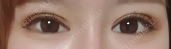 眼瞼下垂（切開） / 隆鼻術 / 鼻尖形成（切開） / 鼻中隔延長（切開） / 軟骨移植 アネシス美容クリニック DAY 17 メイン用