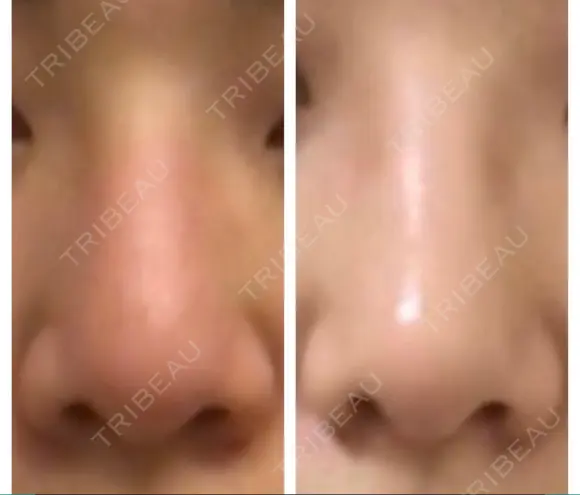 鼻尖形成（切開） / 鼻中隔延長（切開） / 小鼻縮小（切開） / 軟骨移植 / ワシ鼻修正・ハンプ切除 / 鼻尖縮小 カイ整形外科・皮膚科 DAY 16 メイン用
