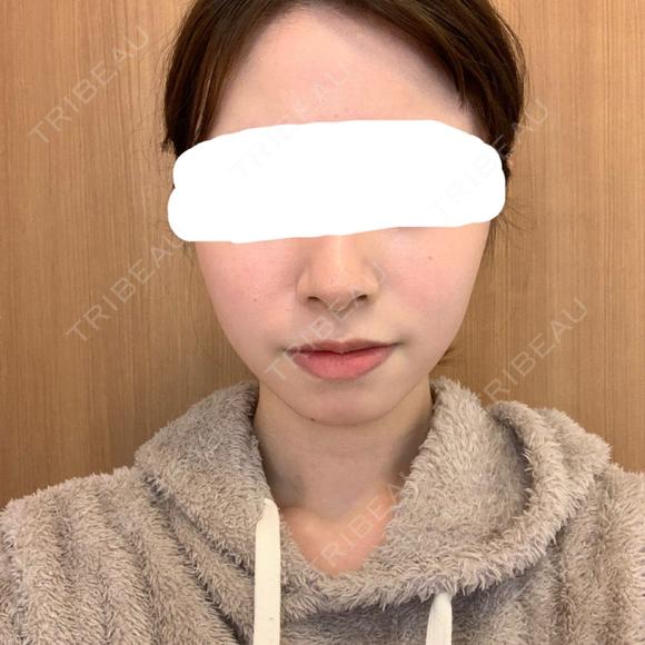 脂肪溶解注射（顔） 赤坂プレミアクリニック DAY 12 メイン用