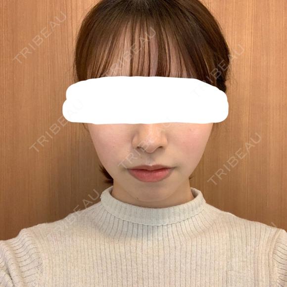 脂肪溶解注射（顔） 赤坂プレミアクリニック DAY 13 メイン用