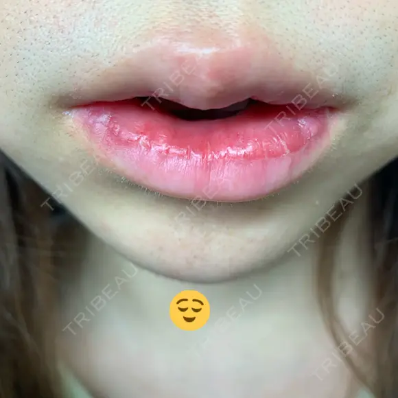 口唇縮小術 / PRP皮膚再生療法 品川美容外科 品川院 DAY 9 メイン用