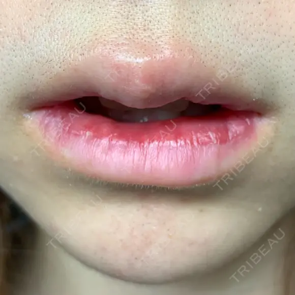 口唇縮小術 / PRP皮膚再生療法 品川美容外科 品川院 DAY 10 メイン用
