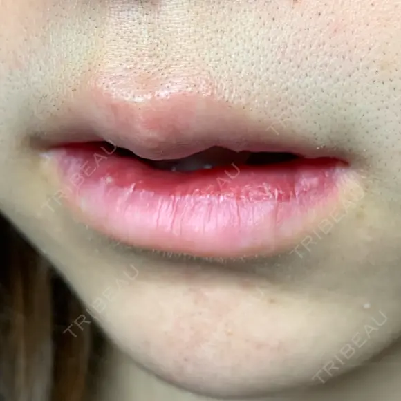 口唇縮小術 / PRP皮膚再生療法 品川美容外科 品川院 DAY 10 メイン用