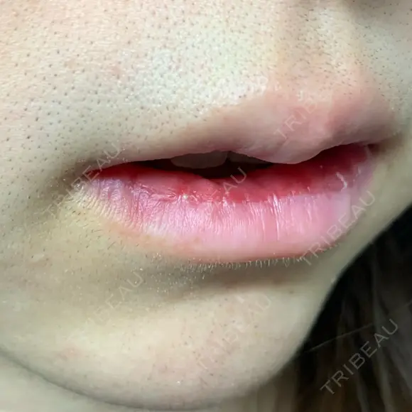 口唇縮小術 / PRP皮膚再生療法 品川美容外科 品川院 DAY 10 メイン用