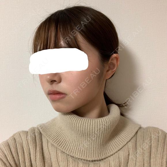 脂肪溶解注射（顔） 赤坂プレミアクリニック DAY 14 メイン用