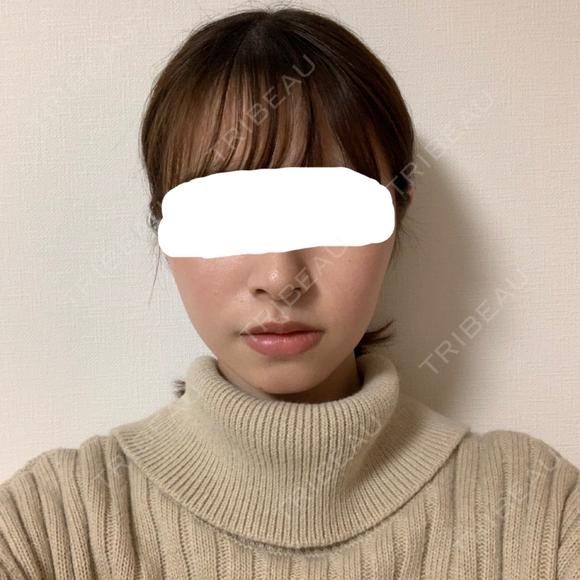 脂肪溶解注射（顔） 赤坂プレミアクリニック AFTER メイン用