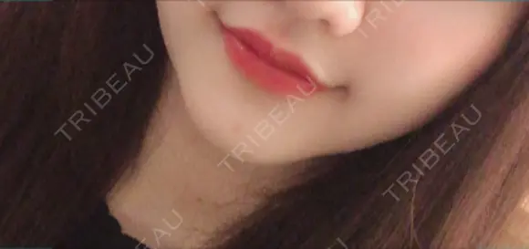 ヒアルロン酸注入（唇） / ボトックス（口角） クリニックA.O. AFTER メイン用