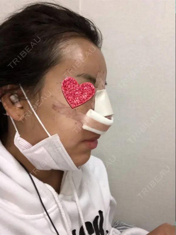 鼻中隔延長（切開） / 小鼻縮小（切開） / 骨切幅寄せ / 水光注射（ハリ・美肌） 韓国BBクリニック（旧 シンミアン形成外科） DAY 0 メイン用