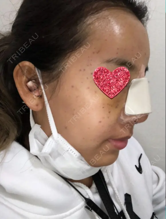 鼻中隔延長（切開） / 小鼻縮小（切開） / 骨切幅寄せ / 水光注射（ハリ・美肌） 韓国BBクリニック（旧 シンミアン形成外科） DAY 1 メイン用