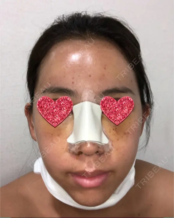 鼻中隔延長（切開） / 小鼻縮小（切開） / 骨切幅寄せ / 水光注射（ハリ・美肌） 韓国BBクリニック（旧 シンミアン形成外科） AFTER メイン用