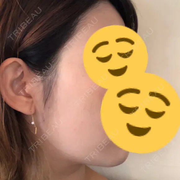 美肌レーザー / 再生医療 / シミ取りレーザー / 美白レーザー KM銀座クリニック DAY 7 メイン用