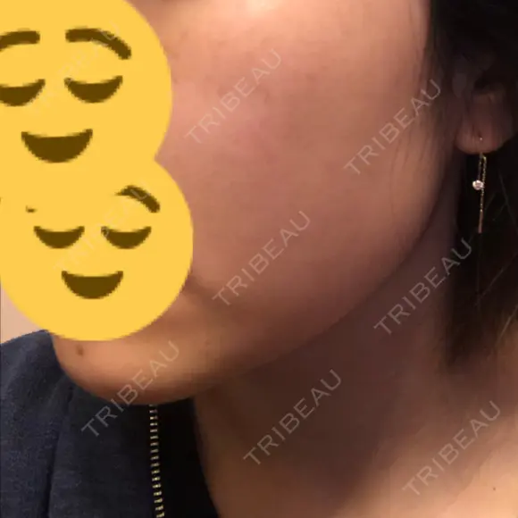 美肌レーザー / 再生医療 / シミ取りレーザー / 美白レーザー KM銀座クリニック DAY 9 メイン用