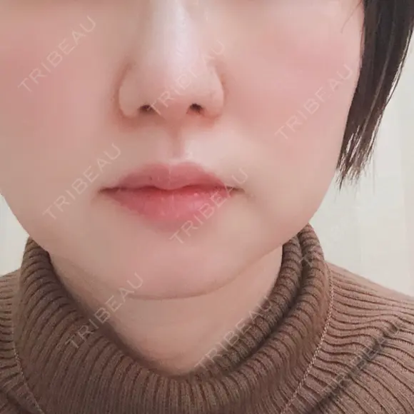 小鼻縮小（切開） / 鼻尖縮小 表参道スキンクリニック 表参道院 DAY 88 メイン用