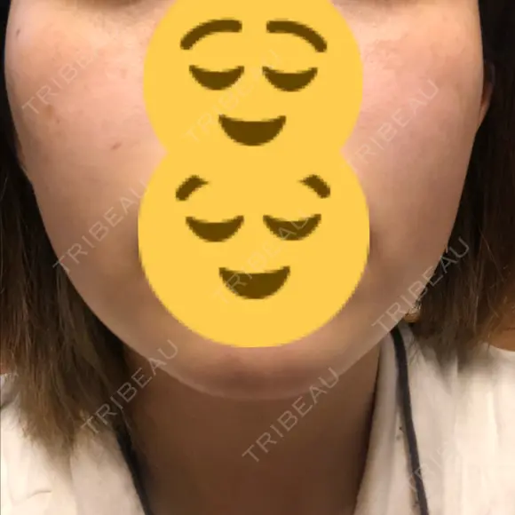 美肌レーザー / 再生医療 / シミ取りレーザー / 美白レーザー KM銀座クリニック AFTER メイン用