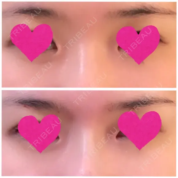 その他（鼻） / 糸リフト / 鼻修正 / ヒアルロン酸注入（額） Beauty Clinic the GINZA DAY 0 メイン用