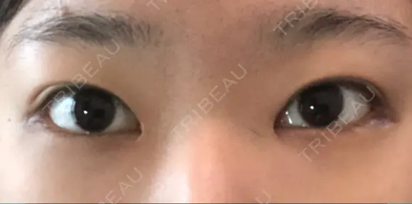 目頭切開 / バッカルファット除去 / 脂肪吸引（顔） / 目尻切開 / タレ目形成・グラマラスライン（切開） / その他（目元） RG整形外科（旧リオン整形外科） AFTER メイン用