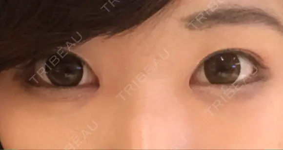 目頭切開 / バッカルファット除去 / 脂肪吸引（顔） / 目尻切開 / タレ目形成・グラマラスライン（切開） / その他（目元） RG整形外科（旧リオン整形外科） DAY 114 メイン用