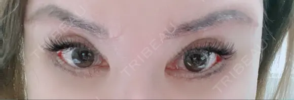 眼瞼下垂（切開） / クマ治療 / 目尻切開 / 下まぶたたるみ取り / 下まぶたの脂肪取り / タレ目形成・グラマラスライン（切開） / 眉下切開 id（アイディ）美容外科 DAY 24 メイン用