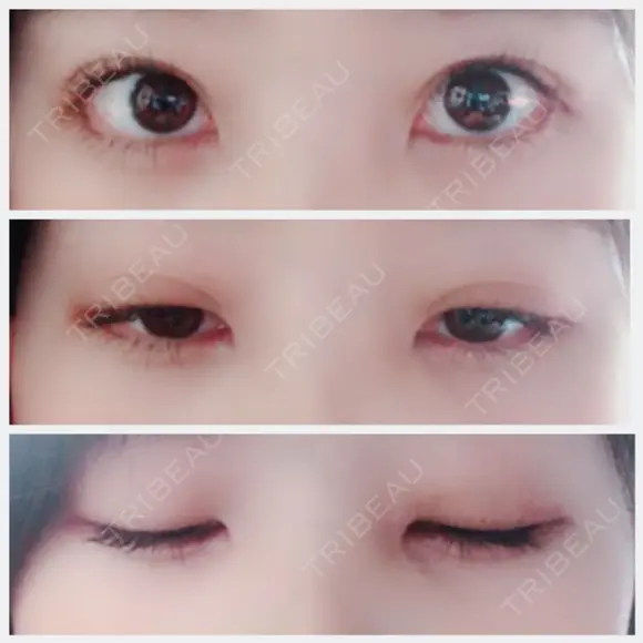 二重埋没 / 眼瞼下垂（切開） / クマ治療 / 下まぶたの脂肪取り THE MEDICAL SALON DAY 54 メイン用