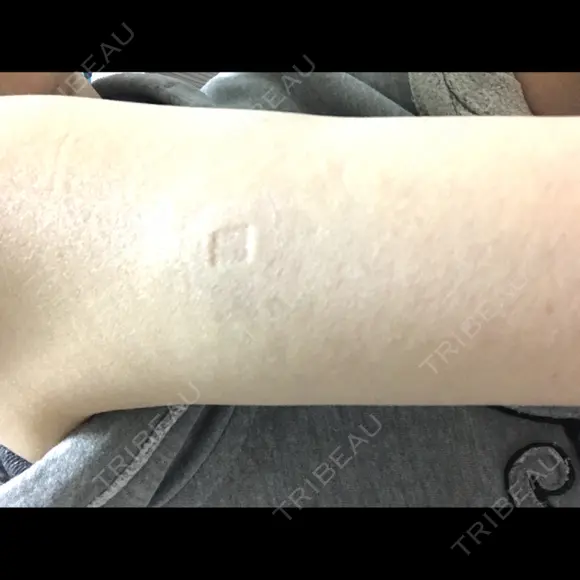 プラセンタ注射 ビクアスクリニック AFTER メイン用