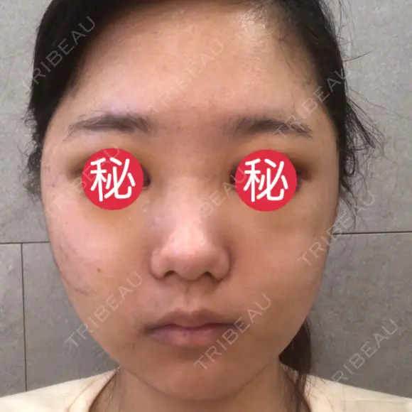 骨削り（頬） RG整形外科（旧リオン整形外科） DAY -394 メイン用