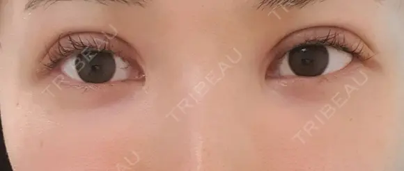 二重切開 CLASSY 仙台美容外科・美容皮膚科 DAY 13 メイン用