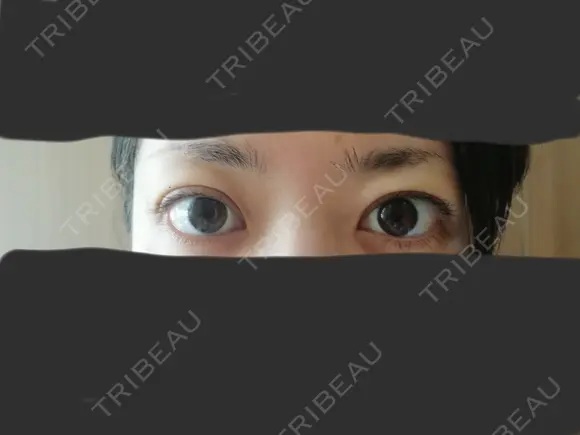 二重埋没 / 小鼻縮小（切開） / その他（鼻） / 骨切り（あご） / 軟骨移植 バノバギ整形外科 DAY 28 メイン用