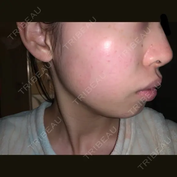 シミ取りレーザー / フォトRF 木本整形外科クリニック アンチエイジング美容外来センター AFTER メイン用