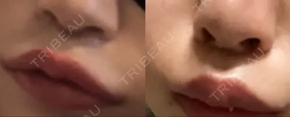 隆鼻術 / 鼻中隔延長（切開） 牧野皮膚科形成外科内科医院 美容外科・形成外科・抗加齢医学外来 AFTER メイン用