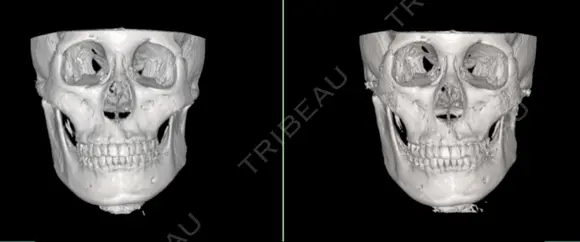 骨削り（頬） RG整形外科（旧リオン整形外科） DAY -394 メイン用