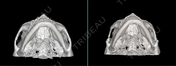 骨削り（頬） RG整形外科（旧リオン整形外科） DAY -394 メイン用