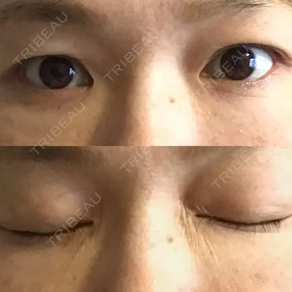 下まぶたたるみ取り セオリークリニック DAY 30 メイン用