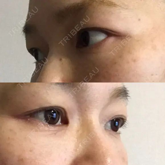 下まぶたたるみ取り セオリークリニック DAY 30 メイン用