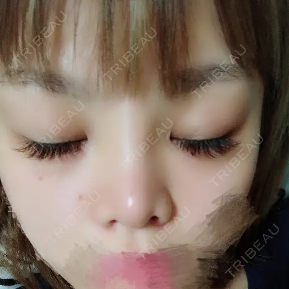 鼻尖形成（切開） / 小鼻縮小（切開） / 軟骨移植 / 眉間プロテーゼ 湘南美容クリニック 広島院 DAY 15 メイン用