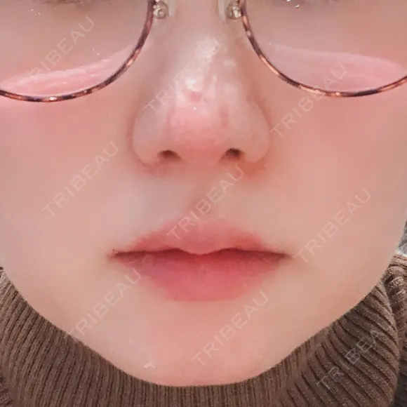 小鼻縮小（切開） / 鼻尖縮小 表参道スキンクリニック 表参道院 AFTER メイン用