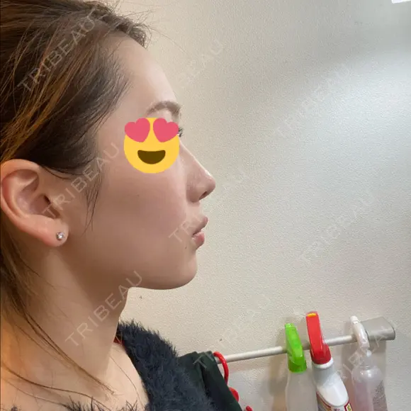 小鼻縮小（切開） / 糸リフト / 鼻尖縮小 / ヒアルロン酸注入（鼻） / ハイフ（顔） ヴェリテクリニック 大阪院 DAY 214 メイン用