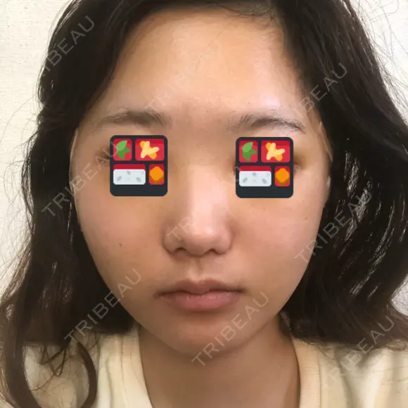 骨削り（頬） RG整形外科（旧リオン整形外科） DAY -391 メイン用