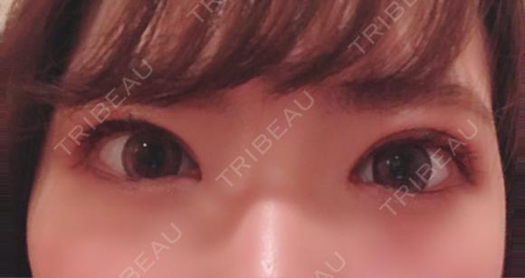 二重切開 / 目頭切開 聖心美容クリニック 札幌院 DAY 32 メイン用