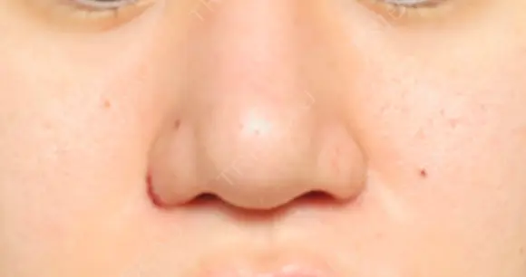 鼻尖形成（切開） / 小鼻縮小（切開） / ヒアルロン酸注入（鼻） 東京ヒルズクリニック 新宿院 DAY 6 メイン用