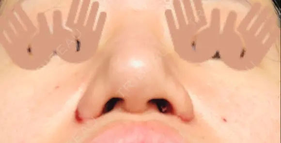 鼻尖形成（切開） / 小鼻縮小（切開） / ヒアルロン酸注入（鼻） 東京ヒルズクリニック 新宿院 DAY 6 メイン用