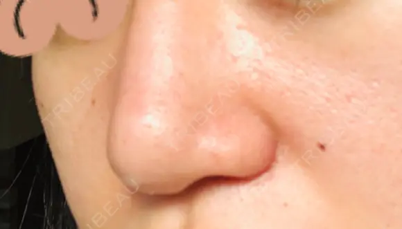 鼻尖形成（切開） / 小鼻縮小（切開） / ヒアルロン酸注入（鼻） 東京ヒルズクリニック 新宿院 DAY 6 メイン用