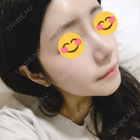 骨切り（あご） / 骨削り（エラ） / 骨削り（頬） / 脂肪吸引（顔） / 脂肪注入（額） / 脂肪溶解注射（顔） View美容整形外科 DAY 115 メイン用