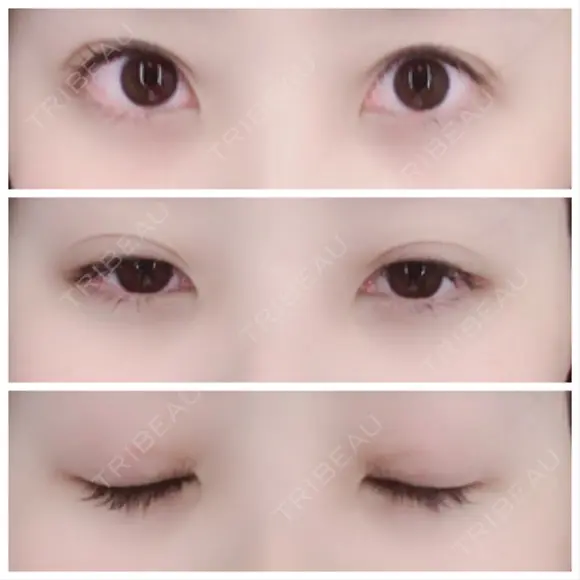 二重埋没 / 眼瞼下垂（切開） / クマ治療 / 下まぶたの脂肪取り THE MEDICAL SALON DAY 62 メイン用