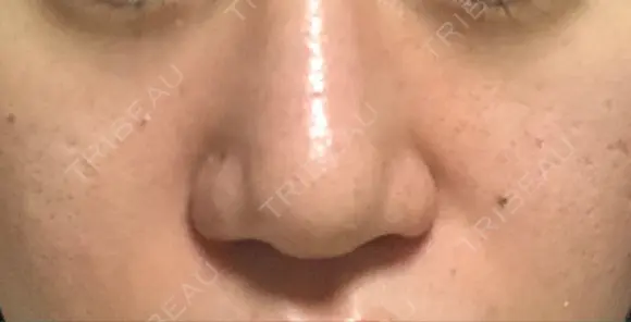 鼻尖形成（切開） / 小鼻縮小（切開） / ヒアルロン酸注入（鼻） 東京ヒルズクリニック 新宿院 DAY 7 メイン用