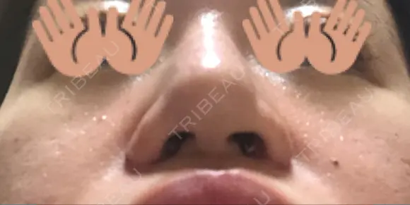 鼻尖形成（切開） / 小鼻縮小（切開） / ヒアルロン酸注入（鼻） 東京ヒルズクリニック 新宿院 DAY 7 メイン用