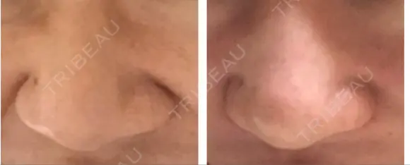 鼻尖形成（切開） / 小鼻縮小（切開） / ヒアルロン酸注入（鼻） 東京ヒルズクリニック 新宿院 DAY 7 メイン用