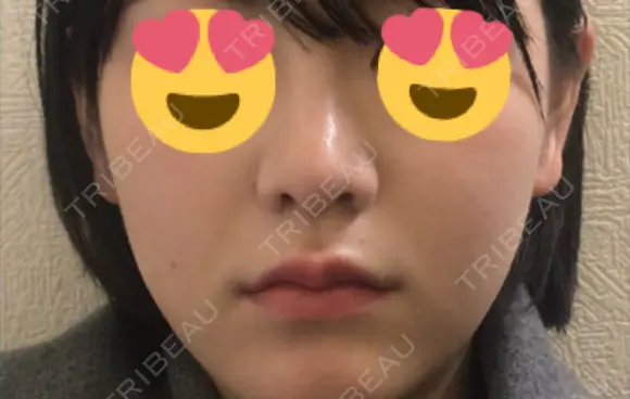 鼻尖形成（切開） / 鼻中隔延長（切開） / 小鼻縮小（切開） / 軟骨移植 / ワシ鼻修正・ハンプ切除 / 鼻尖縮小 カイ整形外科・皮膚科 DAY 31 メイン用