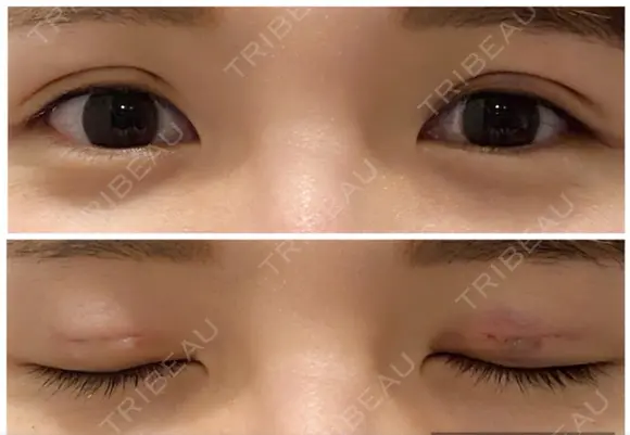 二重埋没 たにまちクリニック DAY 1 メイン用